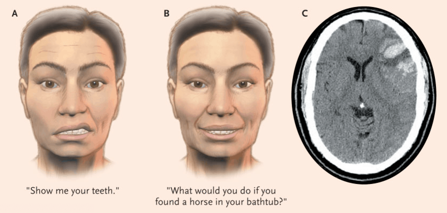 Facial Nerve Palsy examination