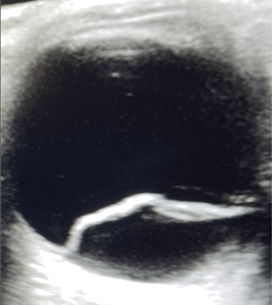 Retinal Detachment