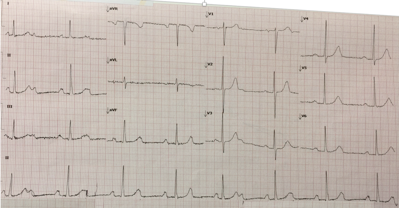 elderly patient ECG 2