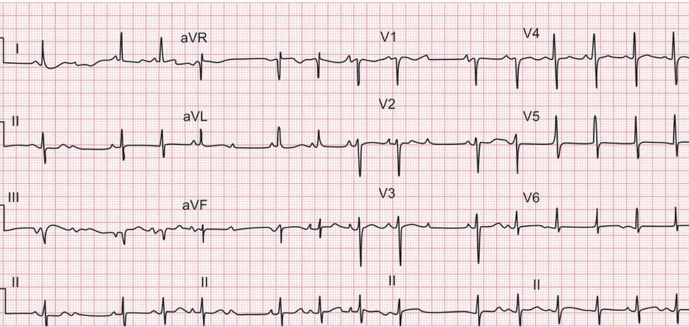 elderly patient ECG 3