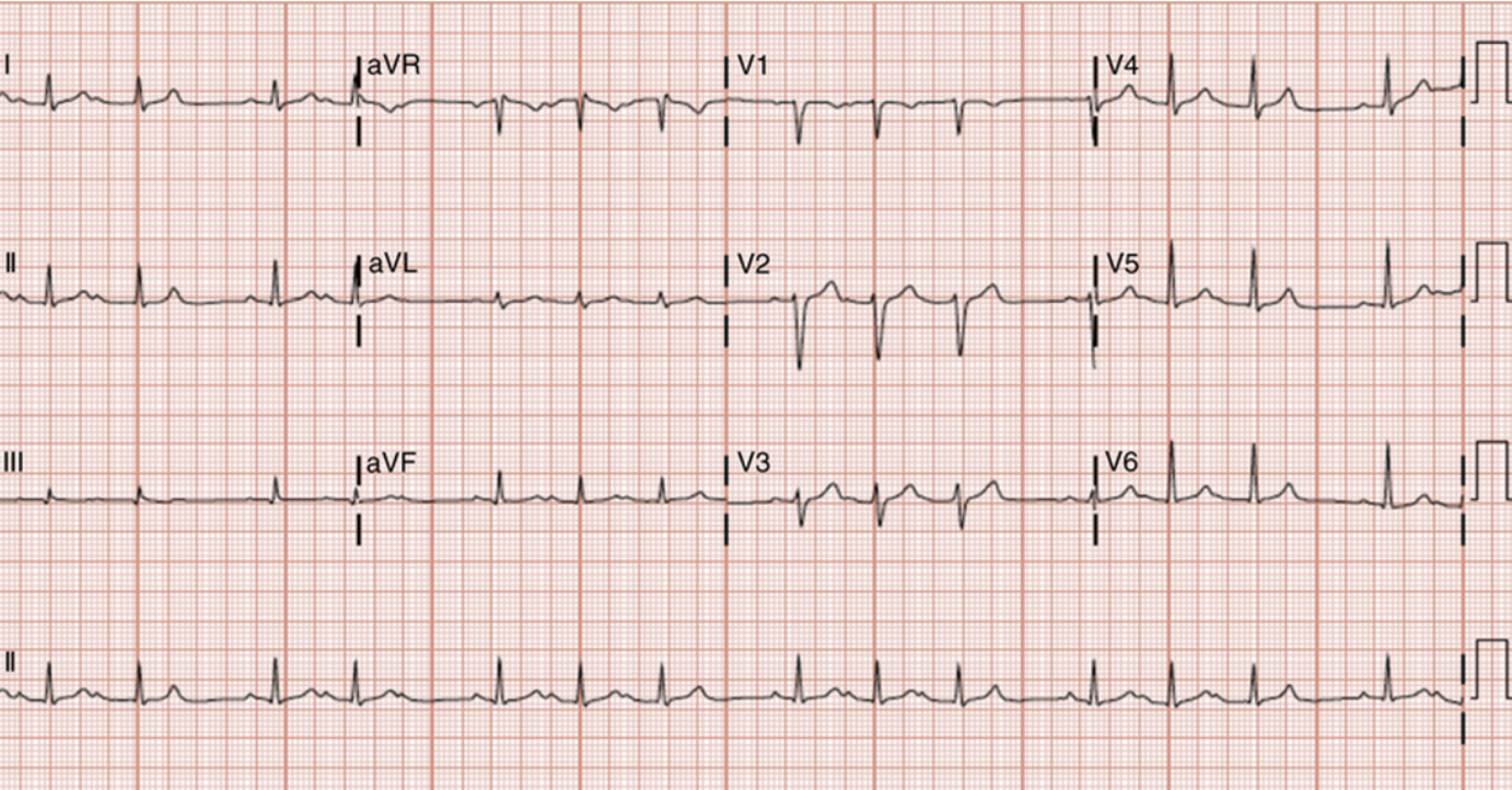 elderly patient ECG 4