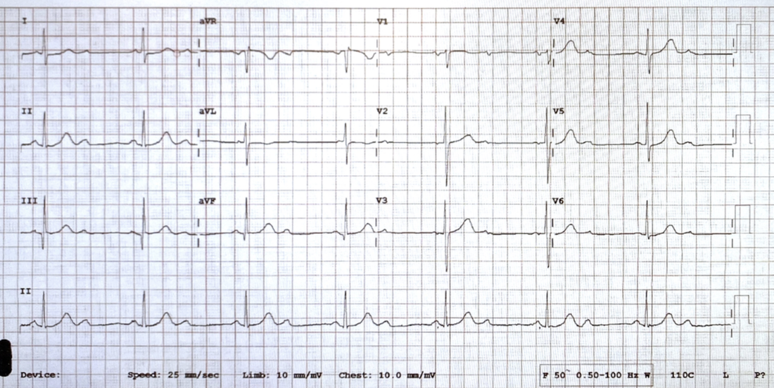 elderly patient ECG