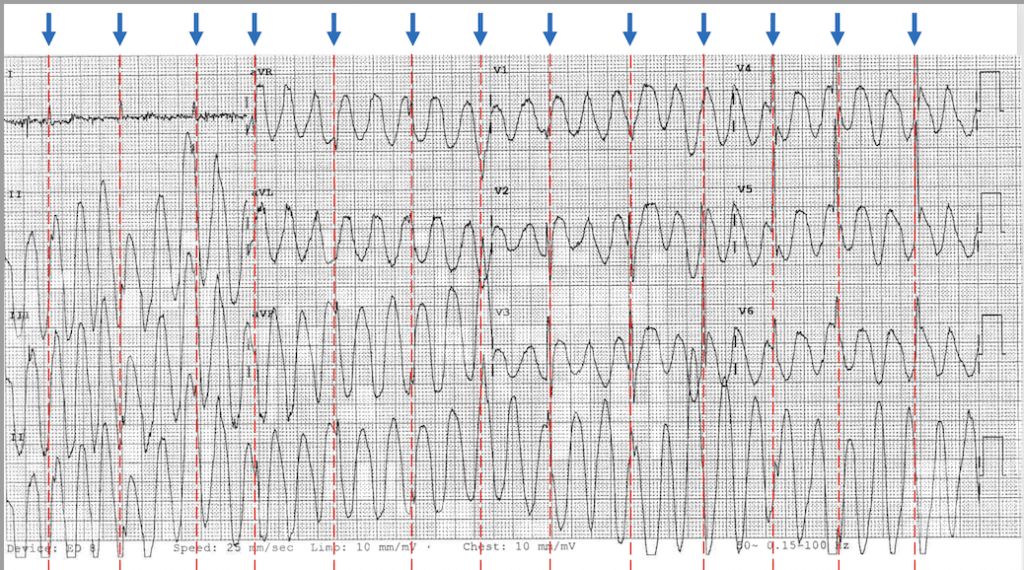 Wide complex tachycardia ECG