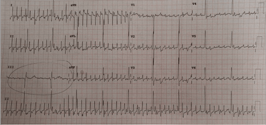 ECG - Cardiology - RESUS