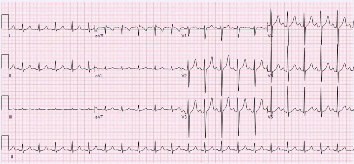 1200px-ecg-sinus-tachycardia-125-bpm_orig-7530853-20230813182907