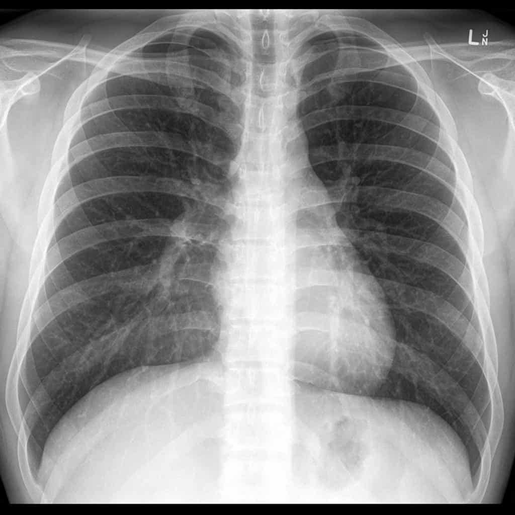 Thoracic Aortic Dissection