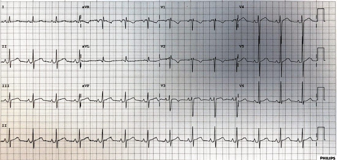 52 yo male - 2 hours chest pain