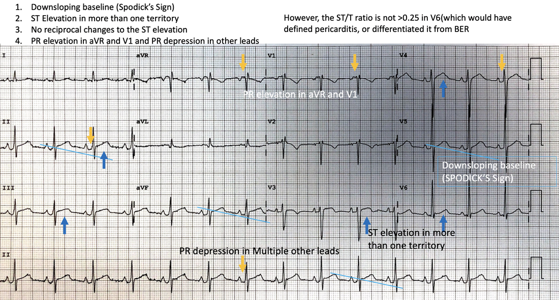 52 yo male - chest pain ECG