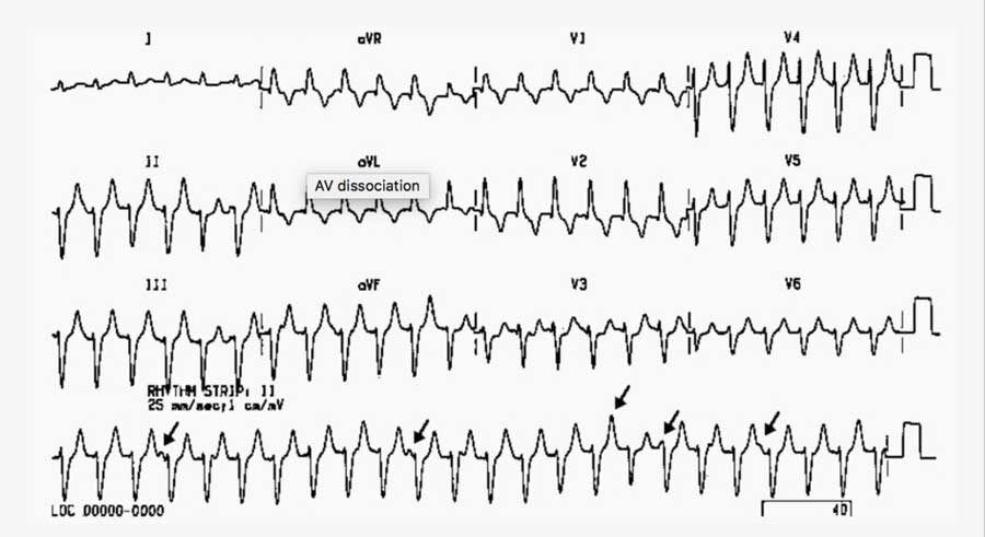 atrioventricular-dissociation_orig-1584561-20230813184444