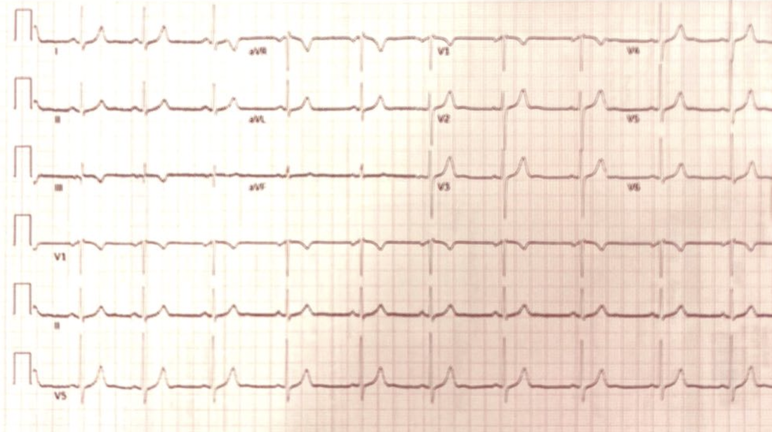 Suspected acute pulmonary embolism