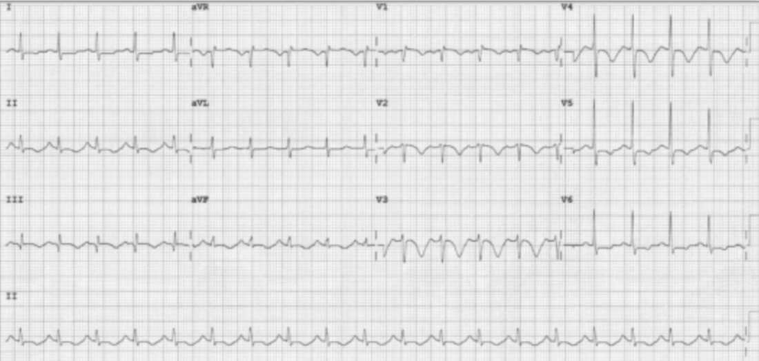 ECG 1