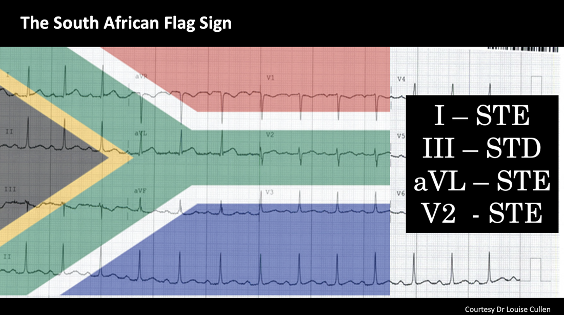 ECG 3 Answer