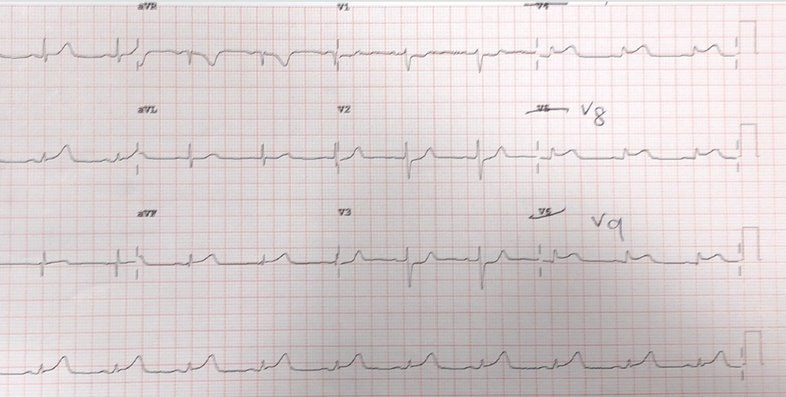 ECG 4 Answer