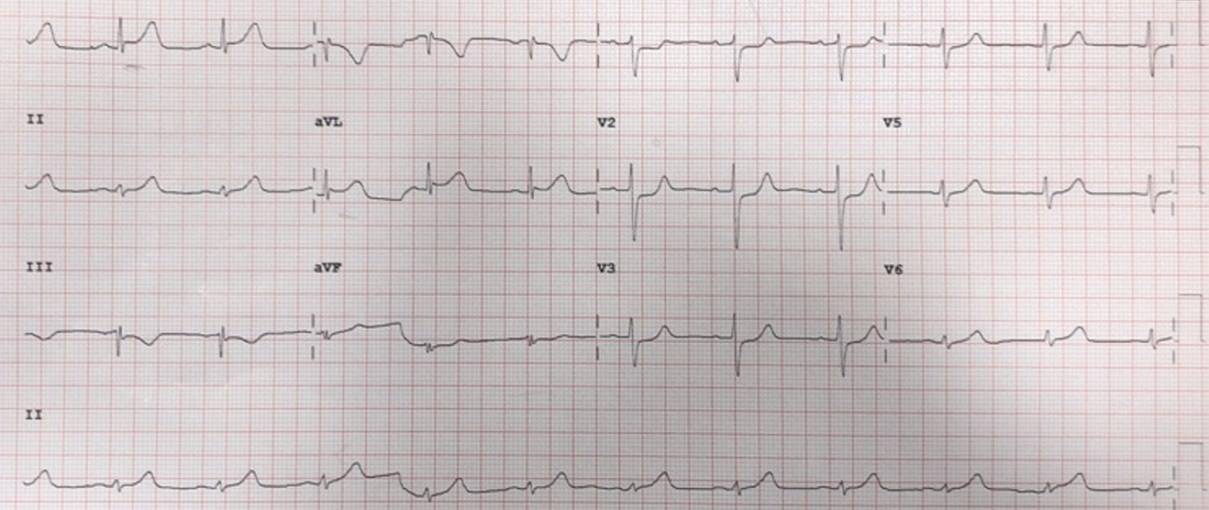 ECG 4