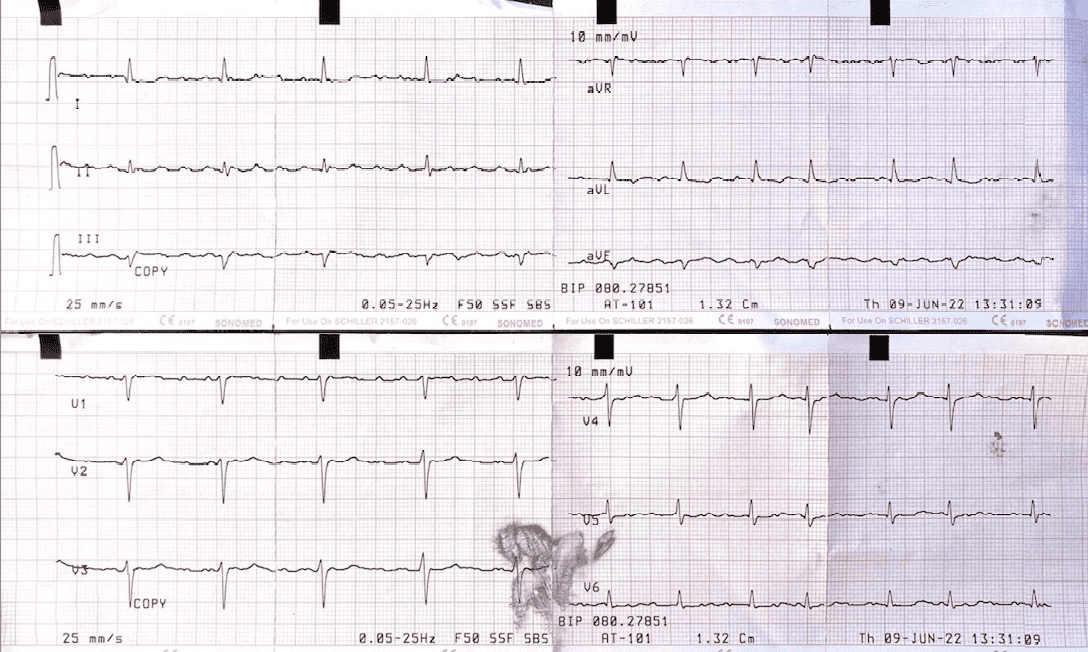 NOACs and a Patient with Palpitations