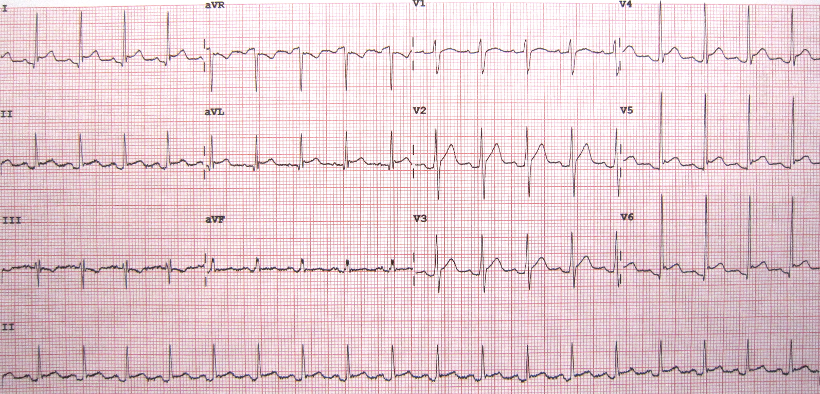 STEMI MIMICS