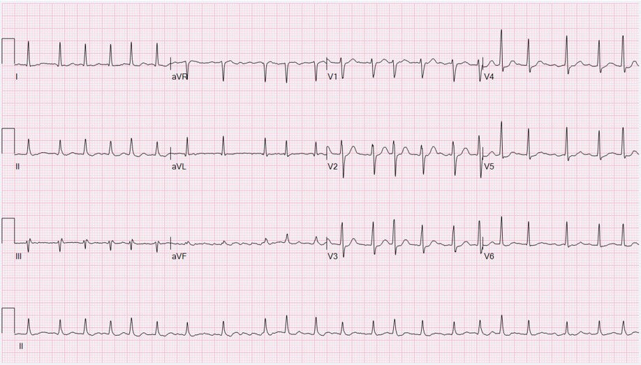 ecg atrial fibrillation