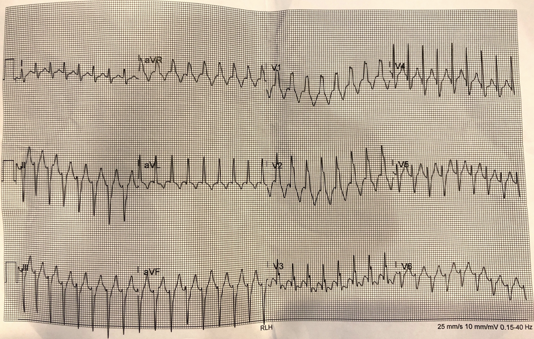 An ECG Challenge: Is it VT or SVT?