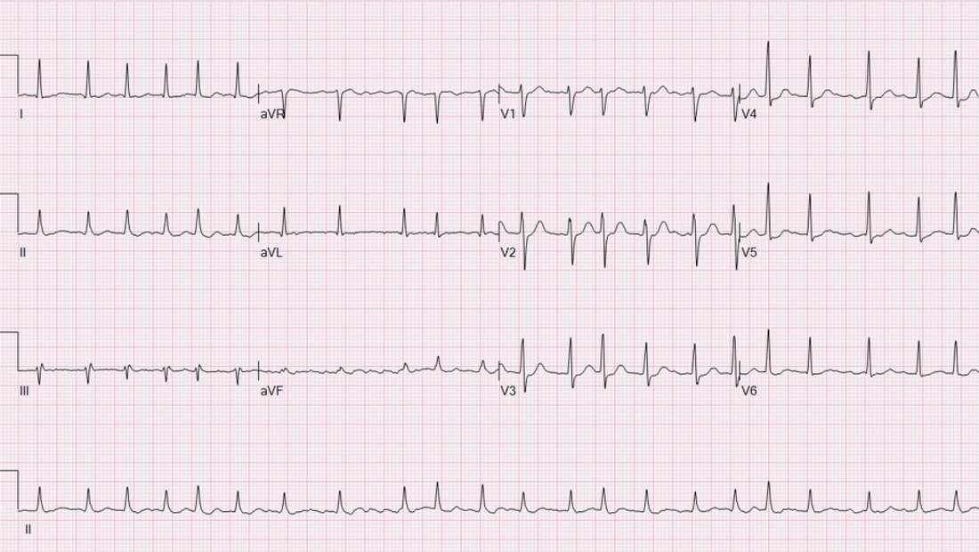 Atrial Fibrillation