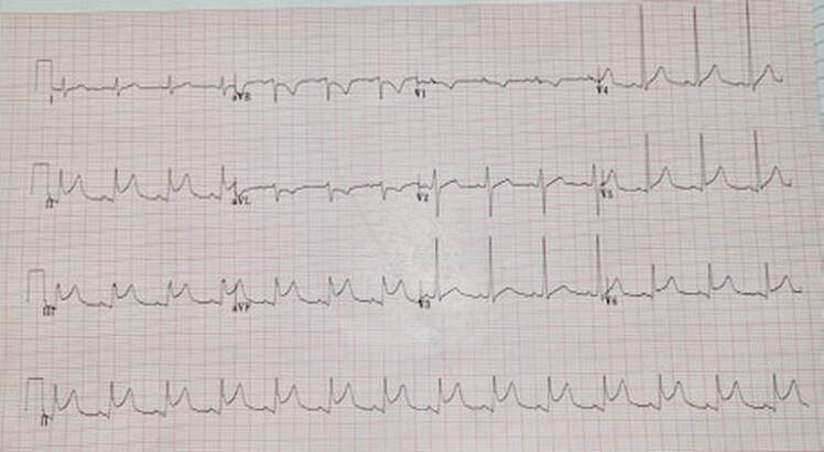 Chest Pain ECG