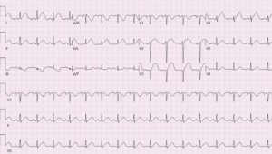 ECG