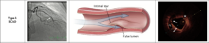 Spontaneous Coronary Artery Dissection