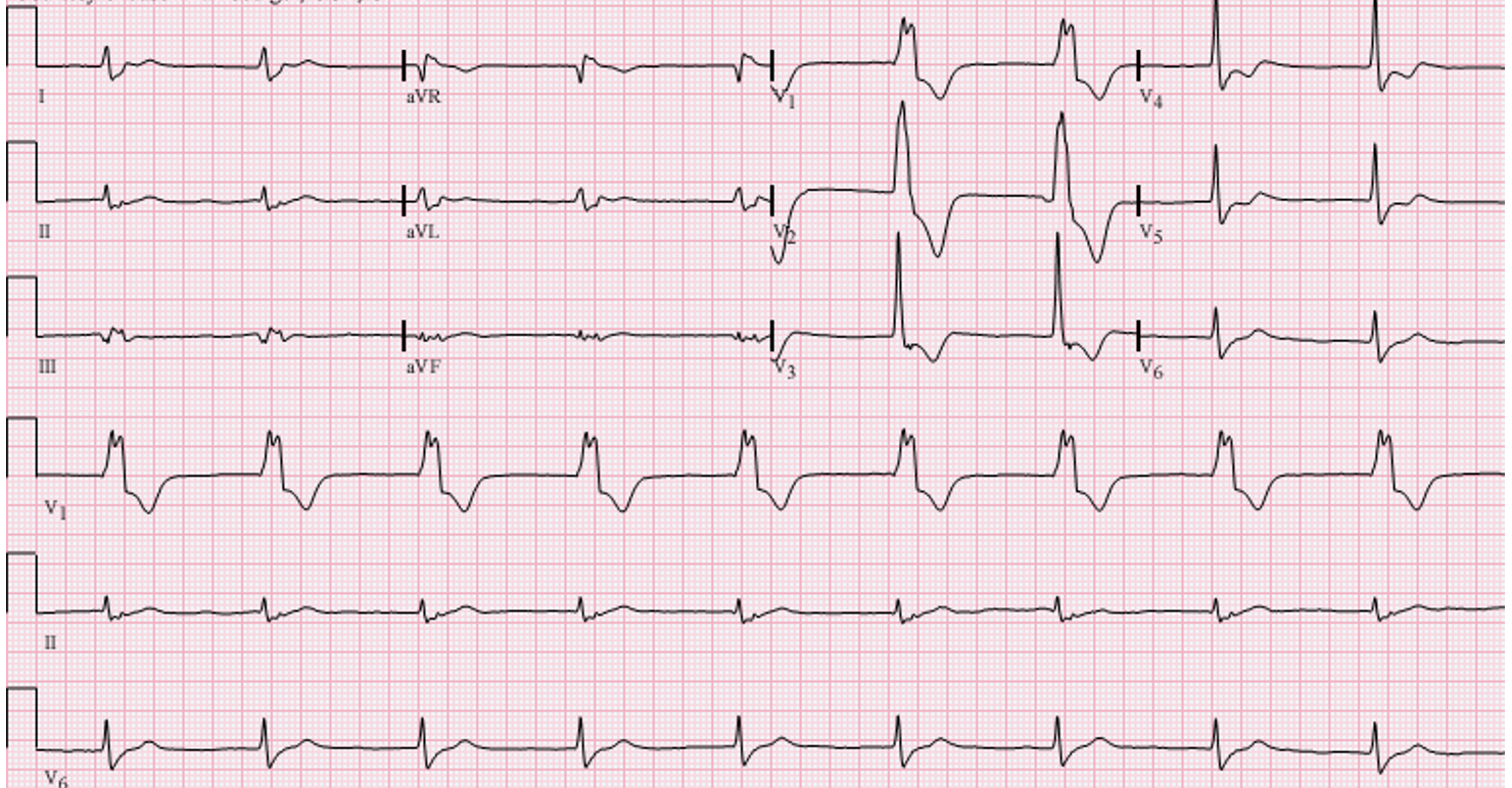 Reperfusion Arrhythmias