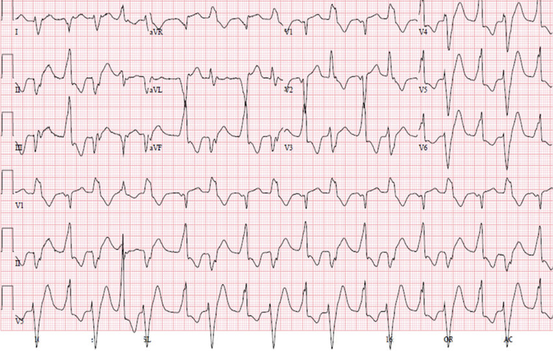 A 12 yo boy with Syncope