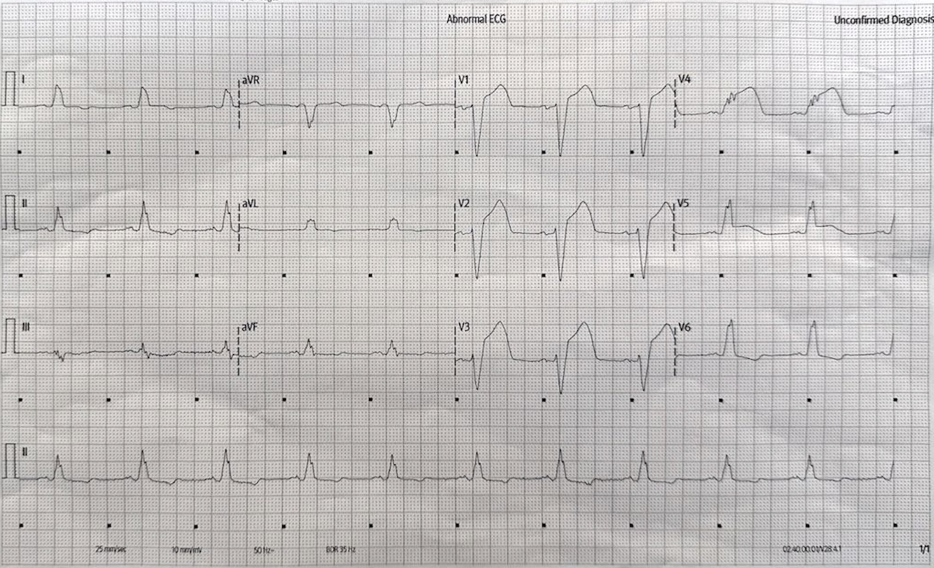 Chest Pain and Left Bundle Branch Block