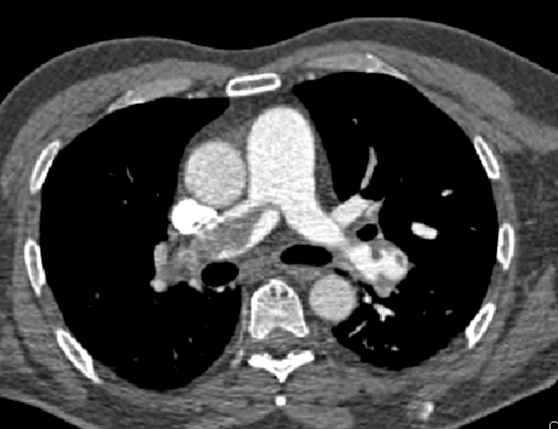 Pulmonary Embolism