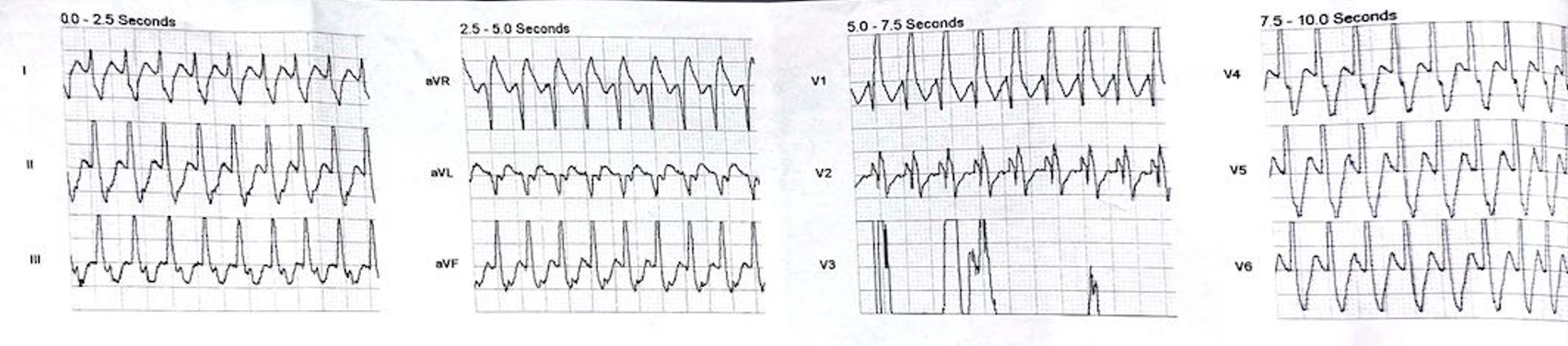 Is this VT or SVT?