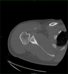 posterior-shoulder-dislocation-10-3