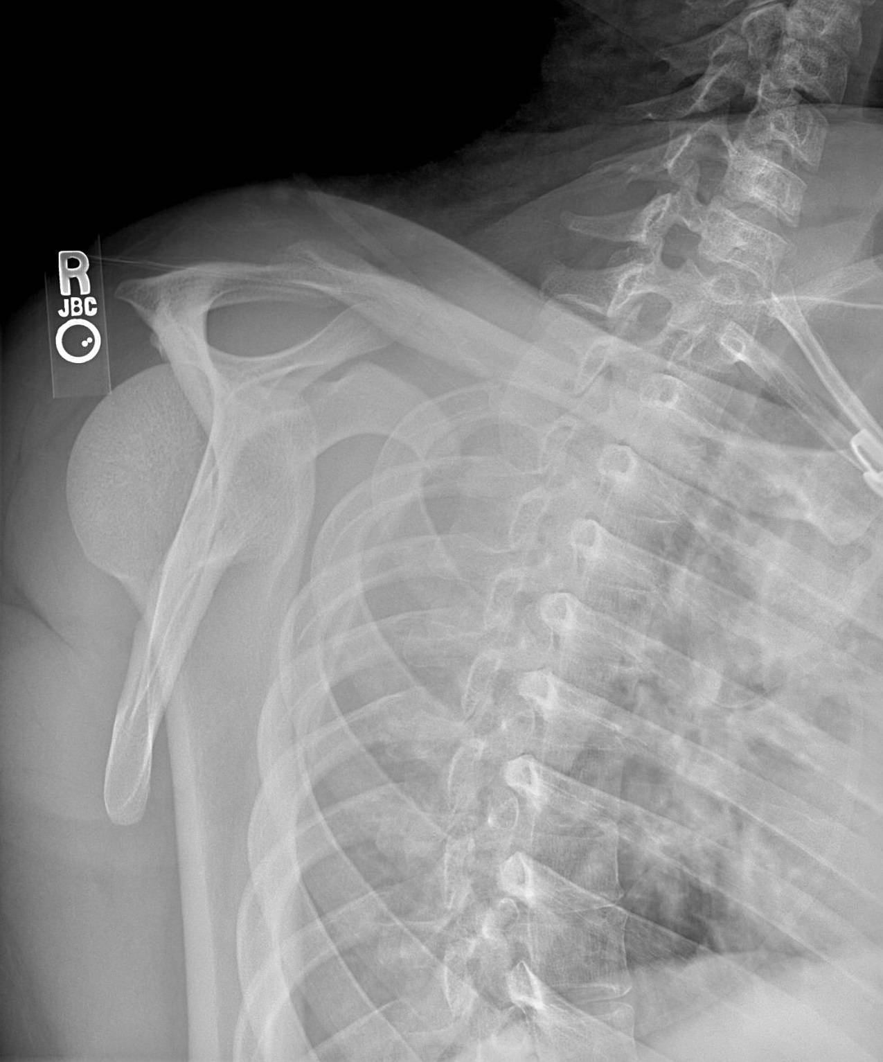 Posterior Shoulder Dislocation